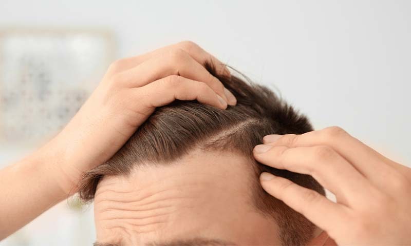 بهترین سن کاشت مو