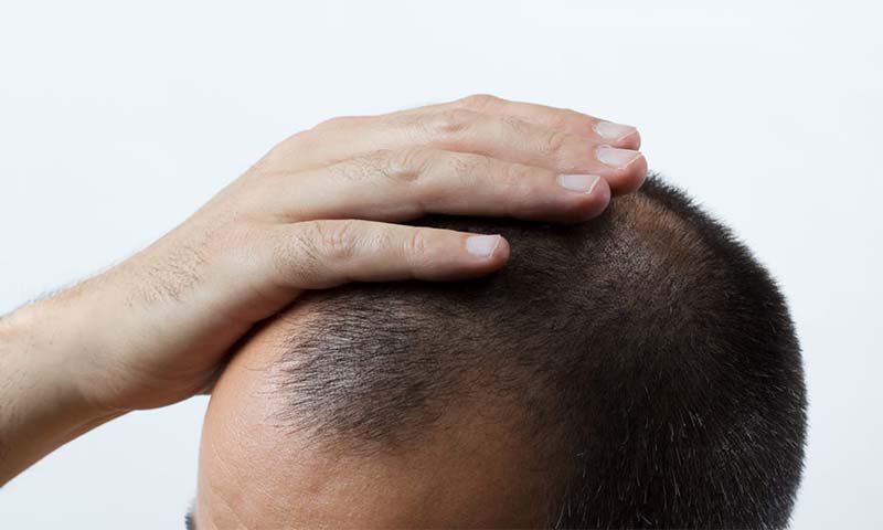 حداکثر سن کاشت مو